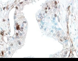PD-ECGF/Thymidine Phosphorylase antibody in Human Prostate Cancer Tissue by Immunohistochemistry (IHC-P).