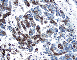 PDGF‑C antibody in Human Pancreatic Cancer Tissue by Immunohistochemistry (IHC-P).