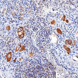 PD-L2/B7-DC antibody in Human Lung Cancer Tissue by Immunohistochemistry (IHC-P).