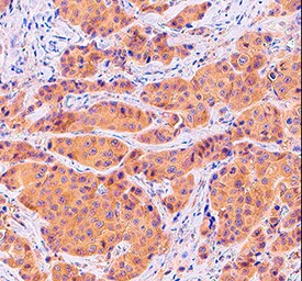 PKCa antibody in Human Breast Cancer Tissue by Immunohistochemistry (IHC-P).
