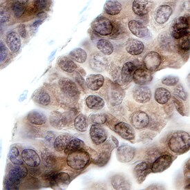 PKCe antibody in Human Lung Cancer Tissue by Immunohistochemistry (IHC-P).