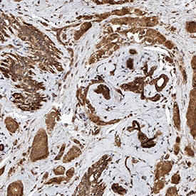 PTGER1 antibody in Human Breast Cancer Tissue by Immunohistochemistry (IHC-P).