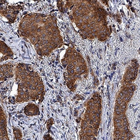 PTGER1 antibody in Human Breast Cancer Tissue by Immunohistochemistry (IHC-P).