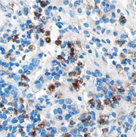 Plexin C1 antibody in Human Melanoma by Immunohistochemistry (IHC-P).