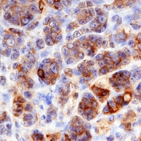Plexin D1 antibody in Human Melanoma by Immunohistochemistry (IHC-P).