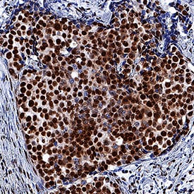 RBBP4 antibody in Human Breast Cancer Tissue by Immunohistochemistry (IHC-P).