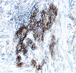 S100A10 antibody in Human Kidney Cancer Tissue by Immunohistochemistry (IHC-P).