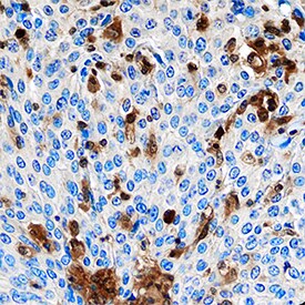S100A4 antibody in Human Cervical Cancer Tissue by Immunohistochemistry (IHC-P).