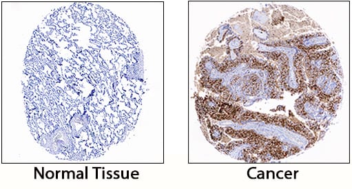 S100A8/S100A9 Heterodimer antibody in Human Lung Cancer Tissue by Immunohistochemistry (IHC-P).