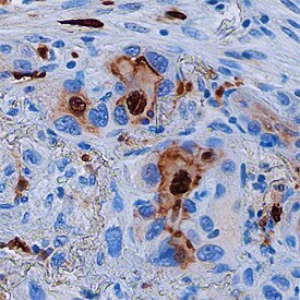 S100A8 antibody in Human Lung Cancer Tissue by Immunohistochemistry (IHC-P).
