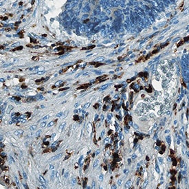 S100A8/S100A9 Heterodimer antibody in Human Colon Cancer Tissue by Immunohistochemistry (IHC-P).