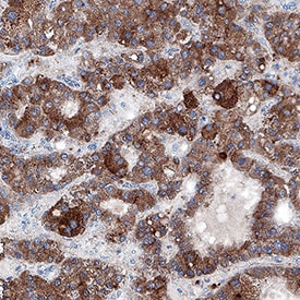 SHBG antibody in Human Hepatocellular Carcinoma Tissue by Immunohistochemistry (IHC-P).