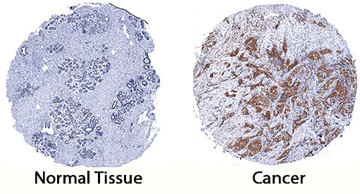 SHIP2 antibody in Human Breast Cancer Tissue by Immunohistochemistry (IHC-P).