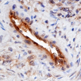 SMOC-2 antibody in Human Ovarian Cancer Tissue by Immunohistochemistry (IHC-P).