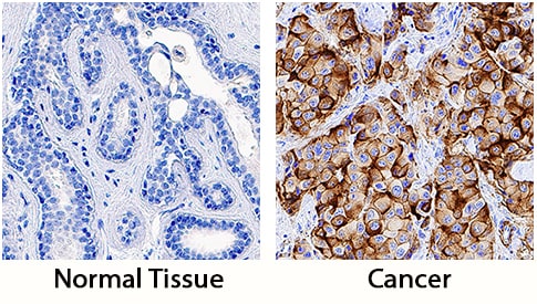 SUSD2 antibody in Human Breast Cancer Tissue by Immunohistochemistry (IHC-P).