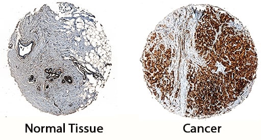 SUSD2 antibody in Human Breast Cancer Tissue by Immunohistochemistry (IHC-P).