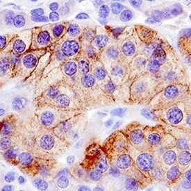 Semaphorin 5A antibody in Human Pancreatic Cancer Tissue by Immunohistochemistry (IHC-P).