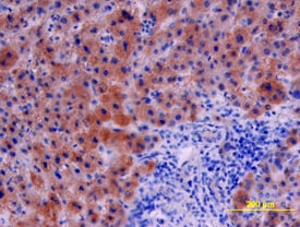 Serpin E1/PAI-1 antibody in Human Liver Cancer Tissue by Immunohistochemistry (IHC-P).
