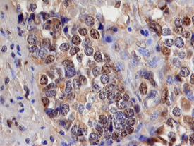 Smad3 antibody in Human Pancreatic Cancer Tissue by Immunohistochemistry (IHC-P).