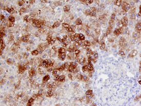 Smad7 antibody in Human Liver Cancer Tissue by Immunohistochemistry (IHC-P).
