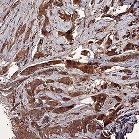 Survivin antibody in Human Breast Cancer Tissue by Immunohistochemistry (IHC-P).