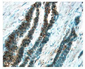 Survivin antibody in Human Prostate Cancer Tissue by Immunohistochemistry (IHC-P).