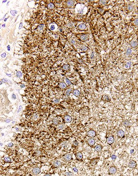 TGF‑a antibody in Human Astrocytoma by Immunohistochemistry (IHC-P).