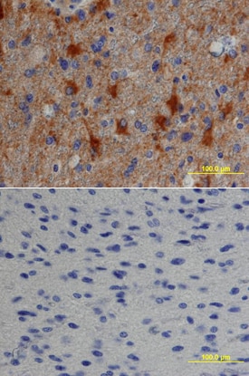 TGF-a antibody in Human Astrocytoma by Immunohistochemistry (IHC-P).