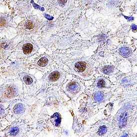 TGIF1 antibody in Human Squamous Cell Carcinoma by Immunohistochemistry (IHC-P).