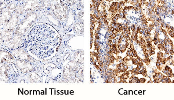 TIM-1/KIM-1/HAVCR antibody in Human Kidney Cancer Tissue by Immunohistochemistry (IHC-P).