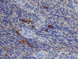 TIMP‑1 antibody in Human Astrocytoma by Immunohistochemistry (IHC-P).