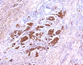 TIMP‑2 antibody in Human Ovarian Cancer Tissue by Immunohistochemistry (IHC-P).