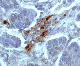 TIMP‑2 antibody in Human Ovarian Cancer Tissue by Immunohistochemistry (IHC-P).