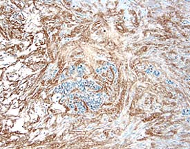 TIMP‑4 antibody in Human Breast Cancer Tissue by Immunohistochemistry (IHC-P).