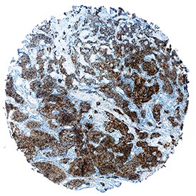 TIMP-2 antibody in Human Pancreatic Cancer Tissue by Immunohistochemistry (IHC-P).