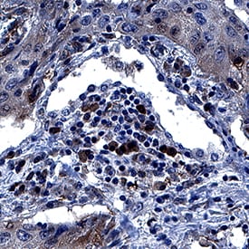 TPT1/TCTP antibody in Human Squamous Cell Carcinoma by Immunohistochemistry (IHC-P).