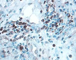 ULBP-2/5/6 antibody in Human Colon Cancer Tissue by Immunohistochemistry (IHC-P).