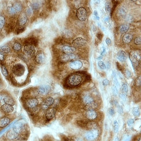 Uteroglobin/SCGB1A1 antibody in Human Endometrial Cancer Tissue by Immunohistochemistry (IHC-P).