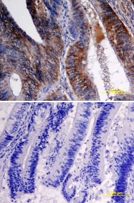 VEGF-C antibody in Human Colon Cancer Tissue by Immunohistochemistry (IHC-P).