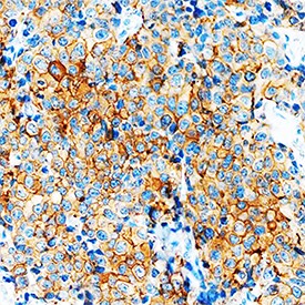 VEGF-B167/186in Human Breast Cancer Tissue by Immunohistochemistry (IHC-P).