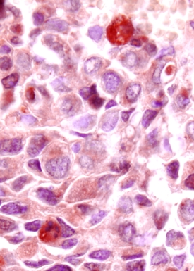 VEGF165in Human Breast Cancer Tissue.