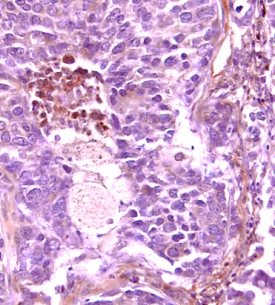 VEGFR1/Flt-1 antibody in Human Breast Cancer Tissue by Immunohistochemistry (IHC-P).