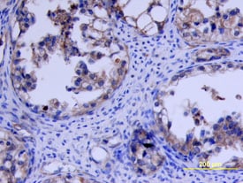 VEGFR1/Flt-1 antibody in Human Ovarian Cancer Tissue by Immunohistochemistry (IHC-P).
