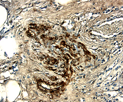 WISP‑1/CCN4 antibody in Human Breast Cancer Tissue by Immunohistochemistry (IHC-P).