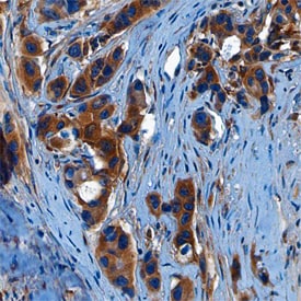 Wnt-10b antibody in Human Breast Cancer Tissue by Immunohistochemistry (IHC-P).
