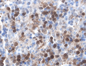 XIAP antibody in Human Lymphoma by Immunohistochemistry (IHC-P).