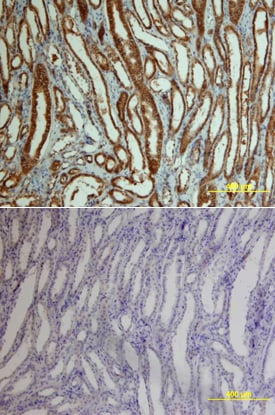 beta -Catenin antibody in Human Kidney Cancer Tissue by Immunohistochemistry (IHC-P).