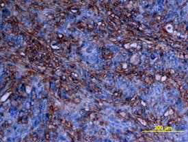 cIAP-2/HIAP-1 antibody in Human Colon Cancer Tissue by Immunohistochemistry (IHC-P).