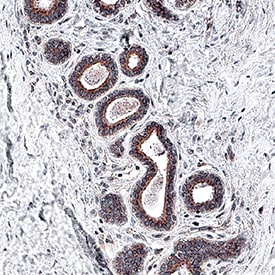 Akt Pan Specific antibody in Human Breast Cancer Tissue by Immunohistochemistry (IHC-P).
