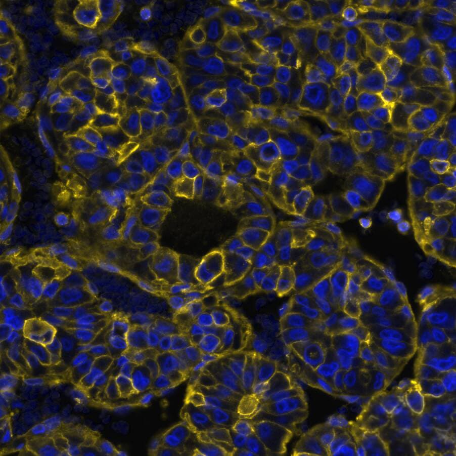 HLA ABC Antibody (MHC-I/8366R) Detection of HLA-ABC/MHC I in Human Liver Tumor via seqIF™ staining on COMET™